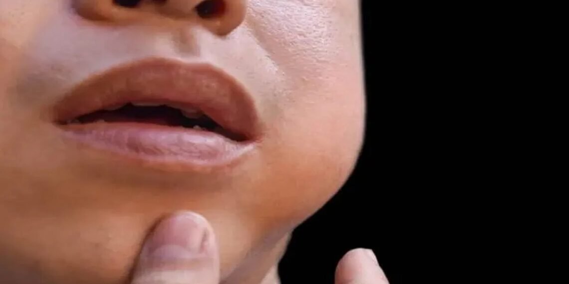 What signs indicate a 190-case daily mumps outbreak in Kerala?