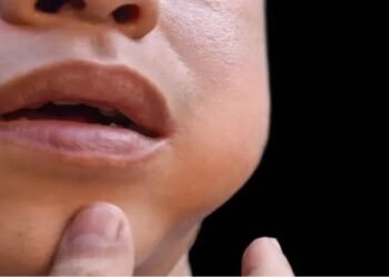 What signs indicate a 190-case daily mumps outbreak in Kerala?