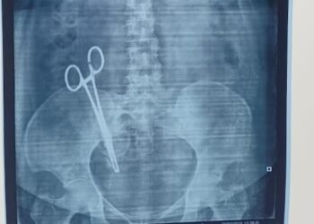 Scissors left in woman’s abdomen during a C-section, taken out after 17 years