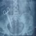 Scissors left in woman’s abdomen during a C-section, taken out after 17 years