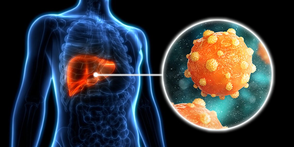 Hepatitis A Cases Spike in Pune: Understanding Causes, Symptoms and Risks